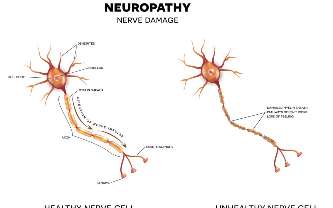 Pijnlijke voeten of polyneuropathie na chemo?