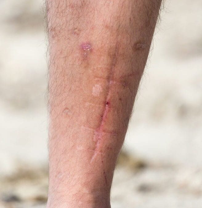 Voetklachten door Littekenweefsel