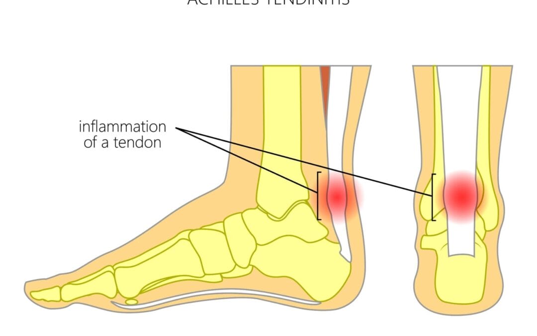Achillespees tendinopathie