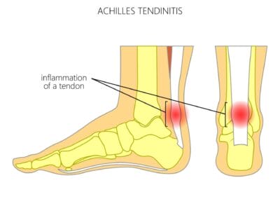 Achillespees tendinopathie